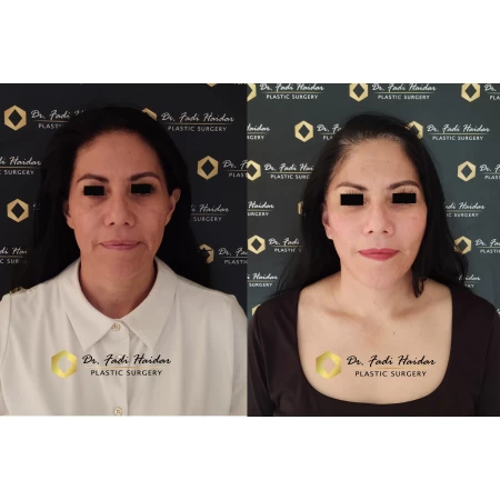 lifting facial resultado 1
