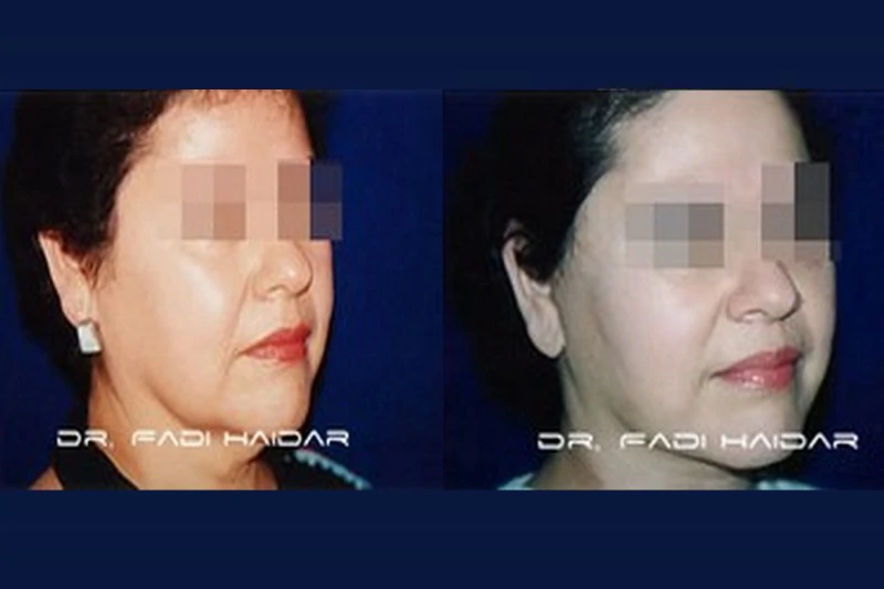 lifting facial resultado 1