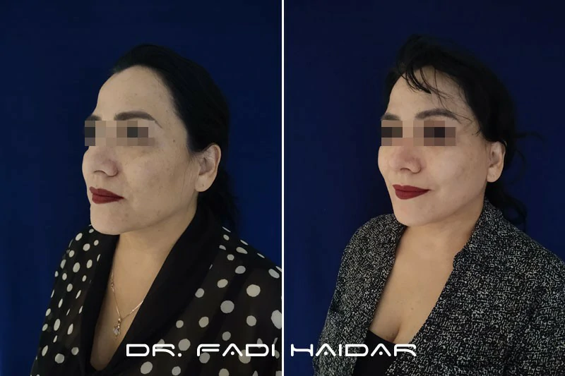 lifting facial precio méxico