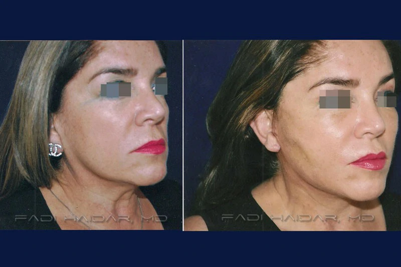 cuanto cuesta lifting facial