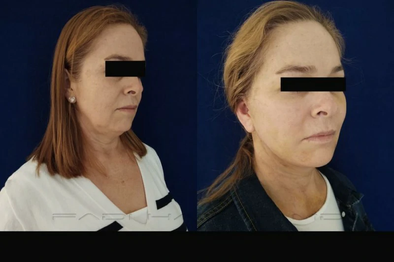 lifting facial sin cirugía alternativas
