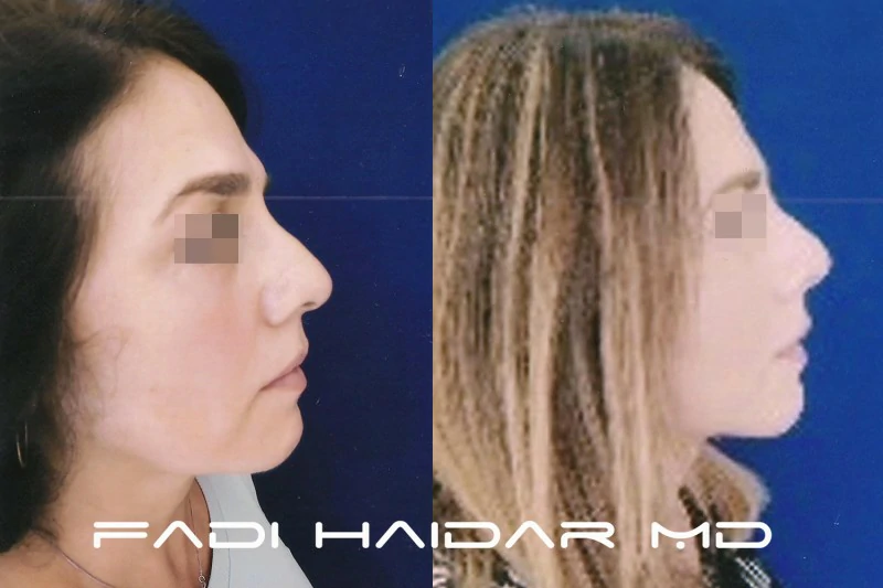 lifting facial resultado 2