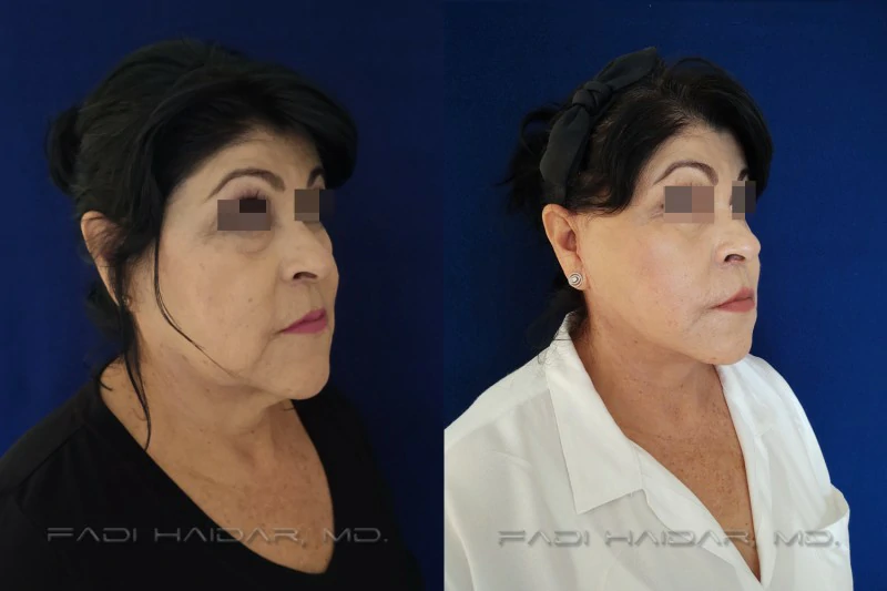 lifting facial guadalajara resultado