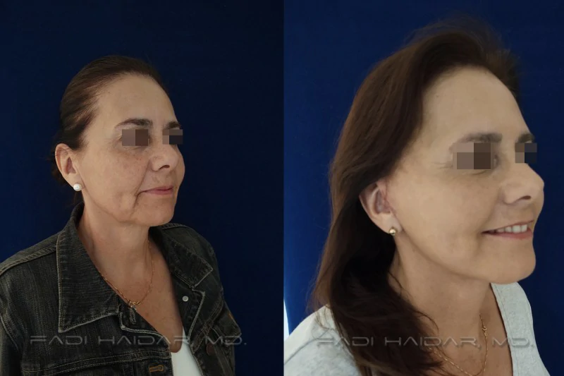 lifting facial antes y después