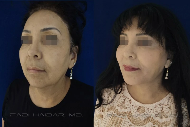 mini lifting facial
