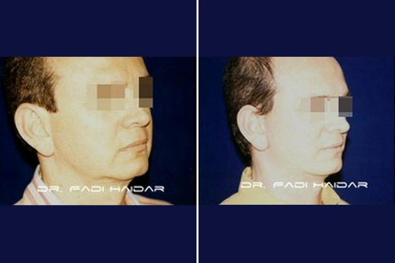 rejuvenecimiento facial