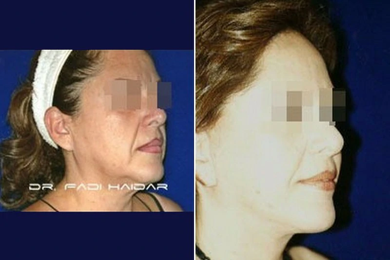 lifting facial postoperatorio