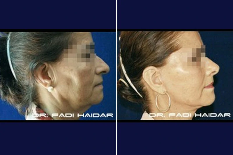 cirugia de rostro