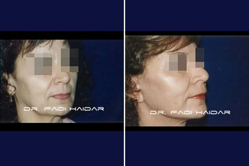 que es lifting facial